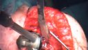 Reverse Delta Prosthesis for a Failed Shoulder Arthroplasty Part 2